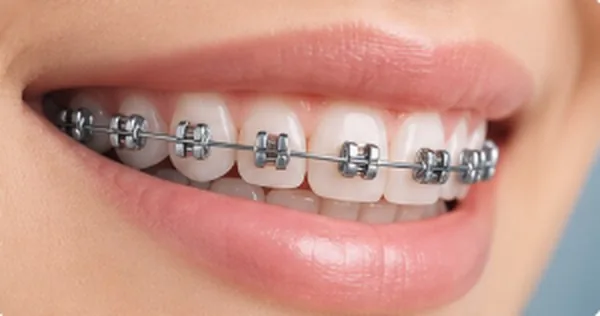 Sonrisa con brackets de autoligado