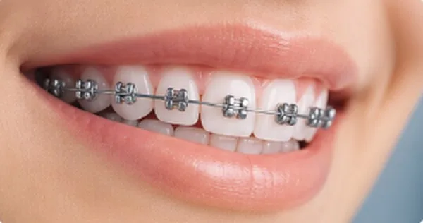 Sonrisa con brackets metálicos