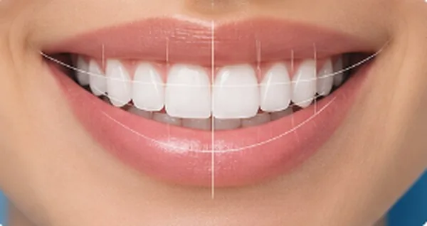 Sonrisa con diseño de sonrisa