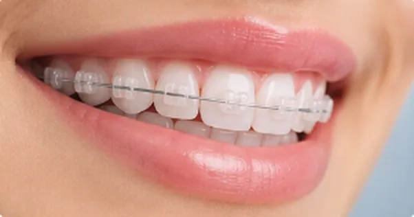 Sonrisa con brackets estéticos transparentes
